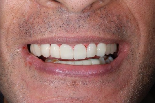 Caso Clinico A - Dopo