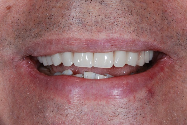 Caso Clinico B - Dopo