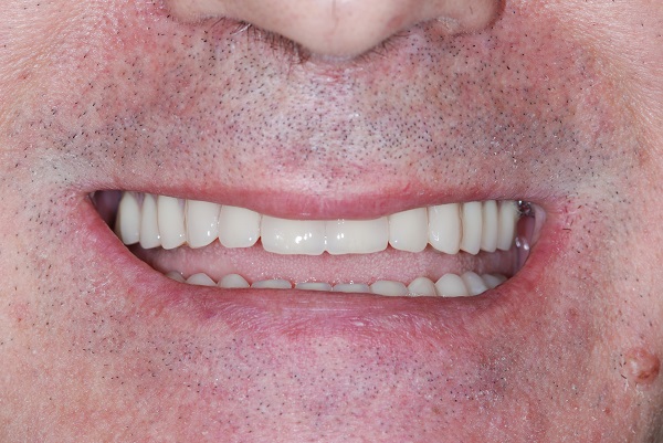 Caso Clinico C - Dopo