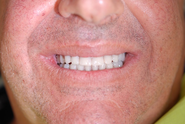 Caso Clinico D - Dopo